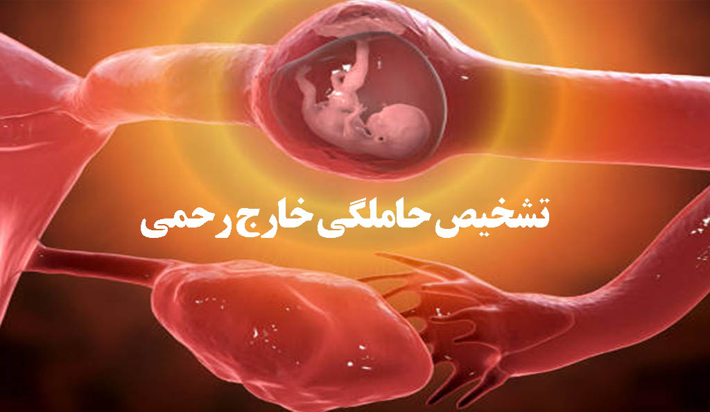 تشخیص حاملگی خارج رحمی