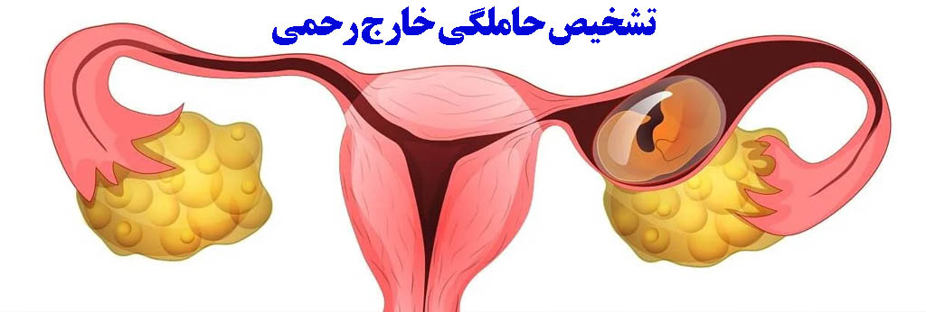 حاملگی خارج رحمی