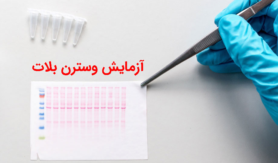 آزمایش وسترن بلات ایدز