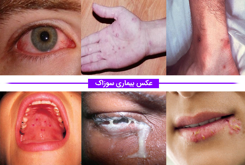 عکس بیماری سوزاک