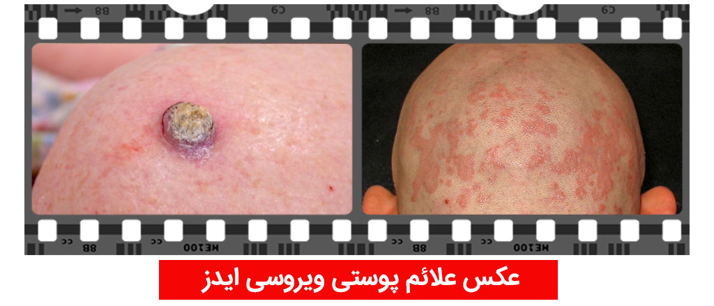 AIDS skin viral infections photo