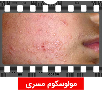 مولوسكوم مسري