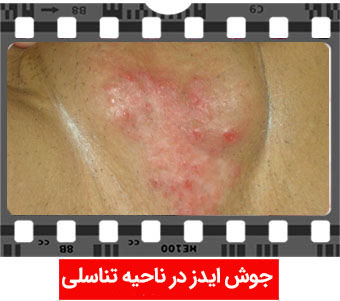 عکس جوش ایدز در ناحیه تناسلی