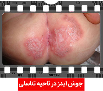 عکس جوش ایدز در ناحیه تناسلی