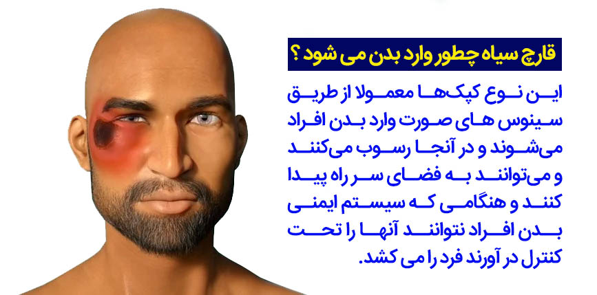 قارچ سیاه چطور وارد بدن می شود