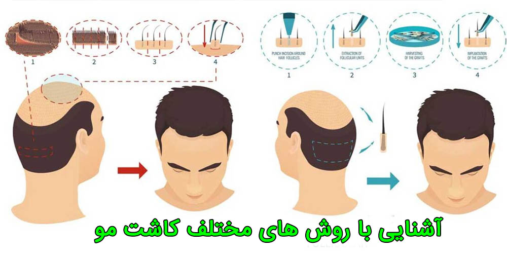 مصرف مواد برای کاشت مو