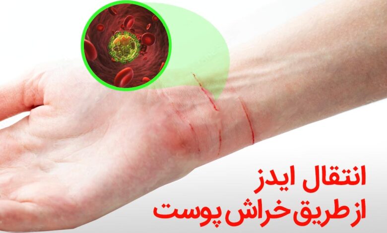 انتقال ایدز از طریق خراش پوست