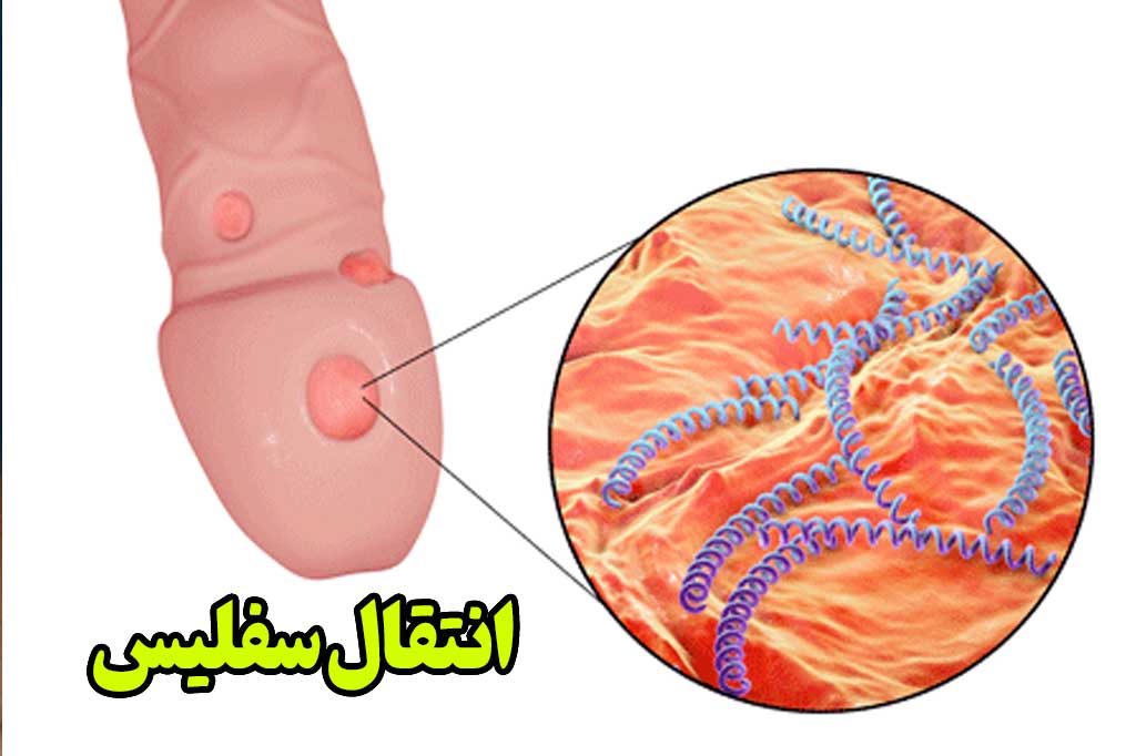 درمان سفلیس چیست