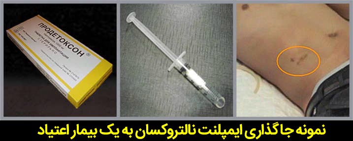 ایمپلنت نالتروکسان