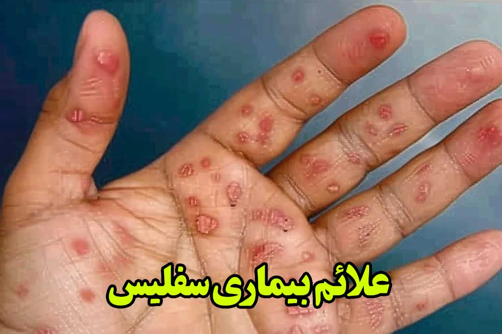 علائم سفلیس