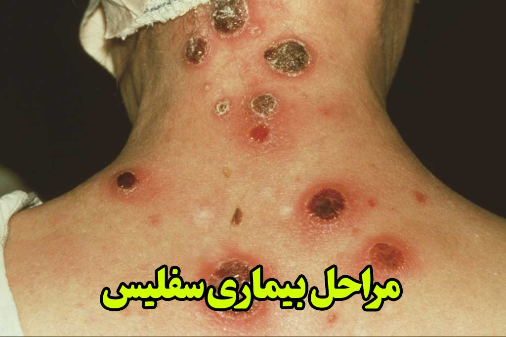 مراحل بیماری سفلیس