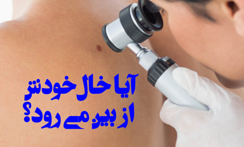 ایا خال خودش از بین می رود