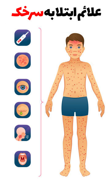 جلوگیری از ابتلا به سرخک
