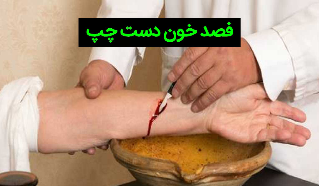 فواید فصد خون دست چپ