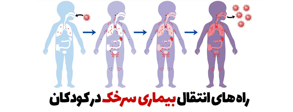 راه سرایت سرخک در کودکان