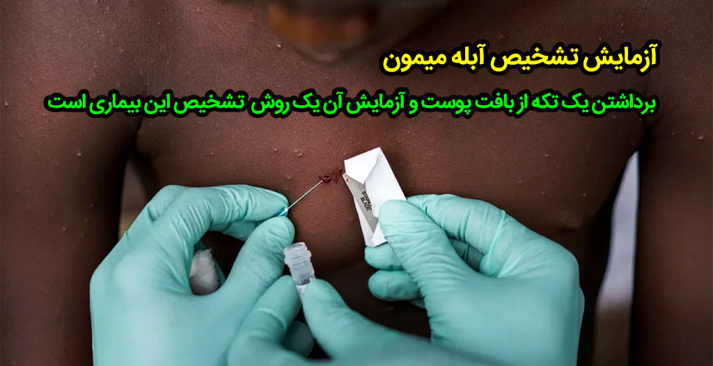 راه تشخیص آبله میمون