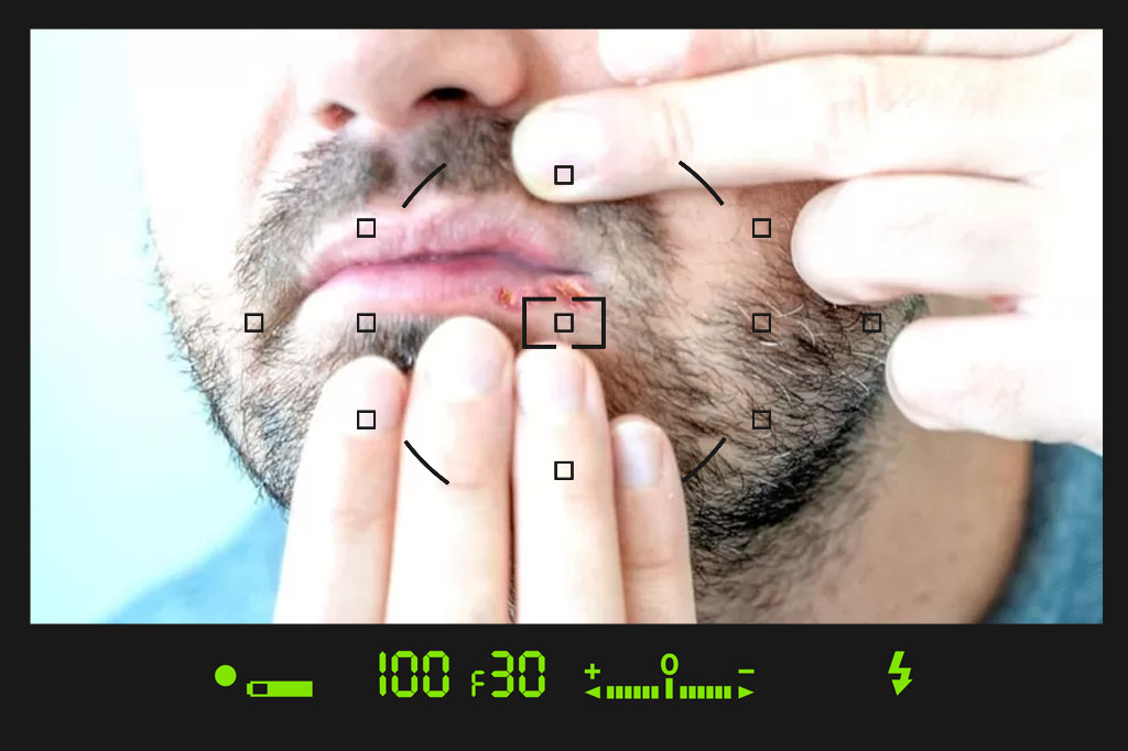 عکس تبخال تناسلی