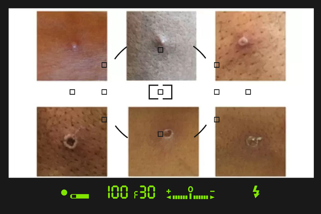 عکس جوش آبله میمون