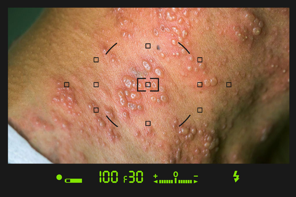 عکس زخم آبله