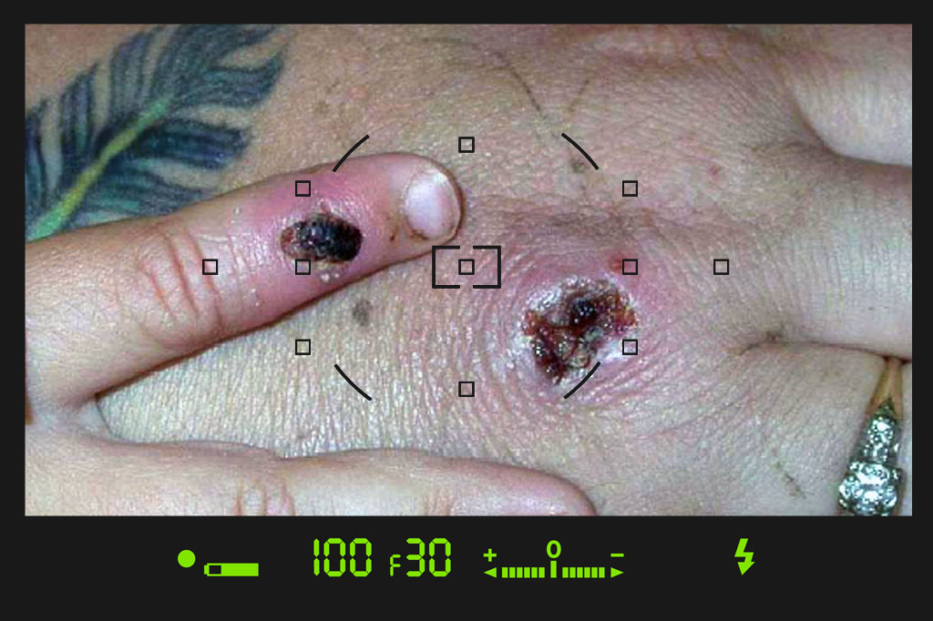 عکس زخم آبله میمون