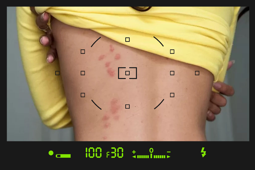 نیش ساس و حشرات