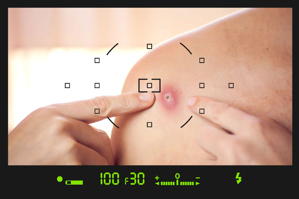 فرق آبله مرغان با آبله میمون