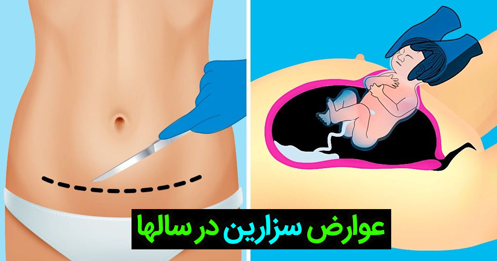 انواع سزارین