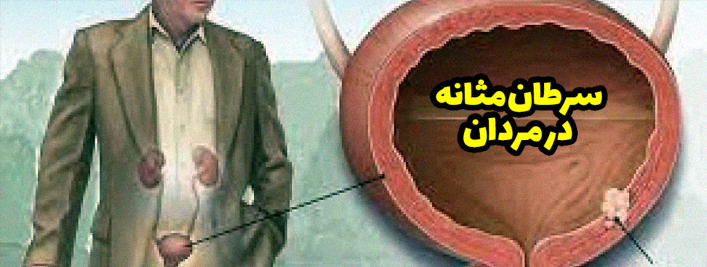 علائم سرطان مثانه در مردان