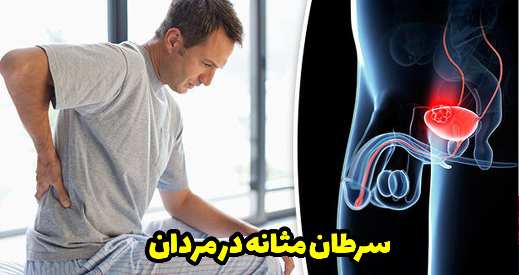 مراحل سرطان مثانه در مردان