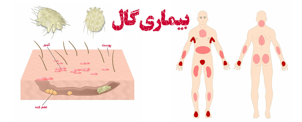 گال بیماری مقاربتی