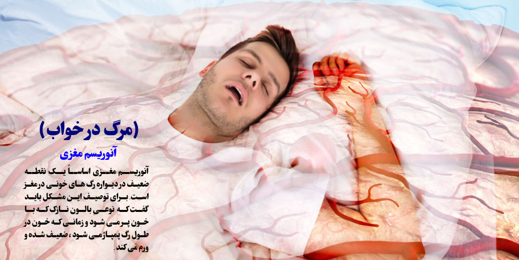 آنوریسم مغزی مرگ در خواب