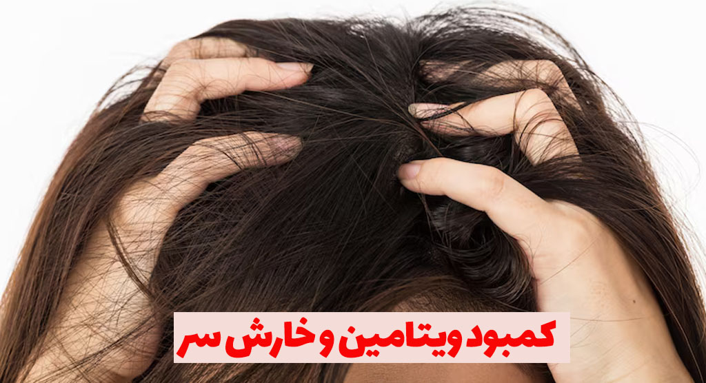 ویتامین و سوزش سر