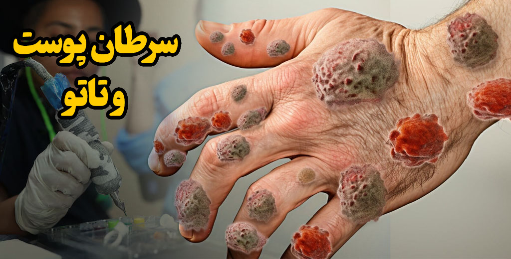 سرطان پوست و تاتو