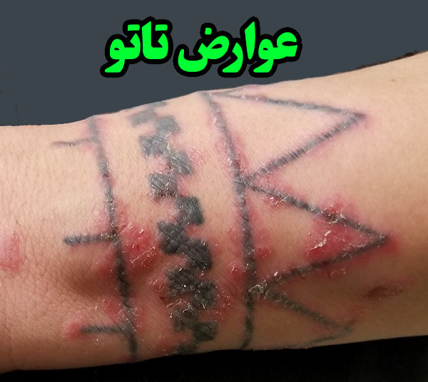 عوارض تتو لب