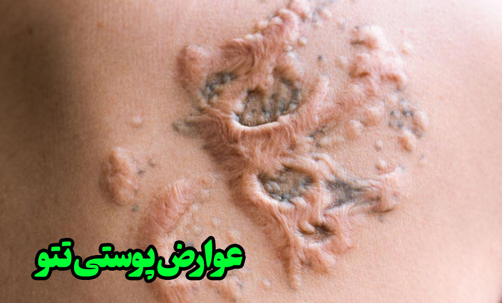 عوارض پوستی تاتو