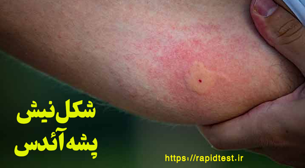 شکل نیش پشه آدیس