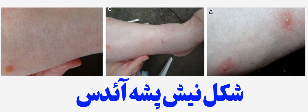 عکس جای نیش پشه دنگی