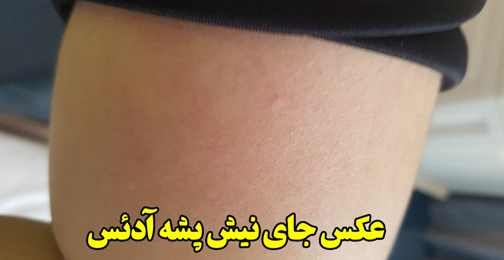 عکس محل نیش پشه آدئس