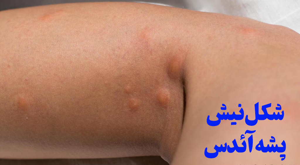 عکس نیش پشه آدیس