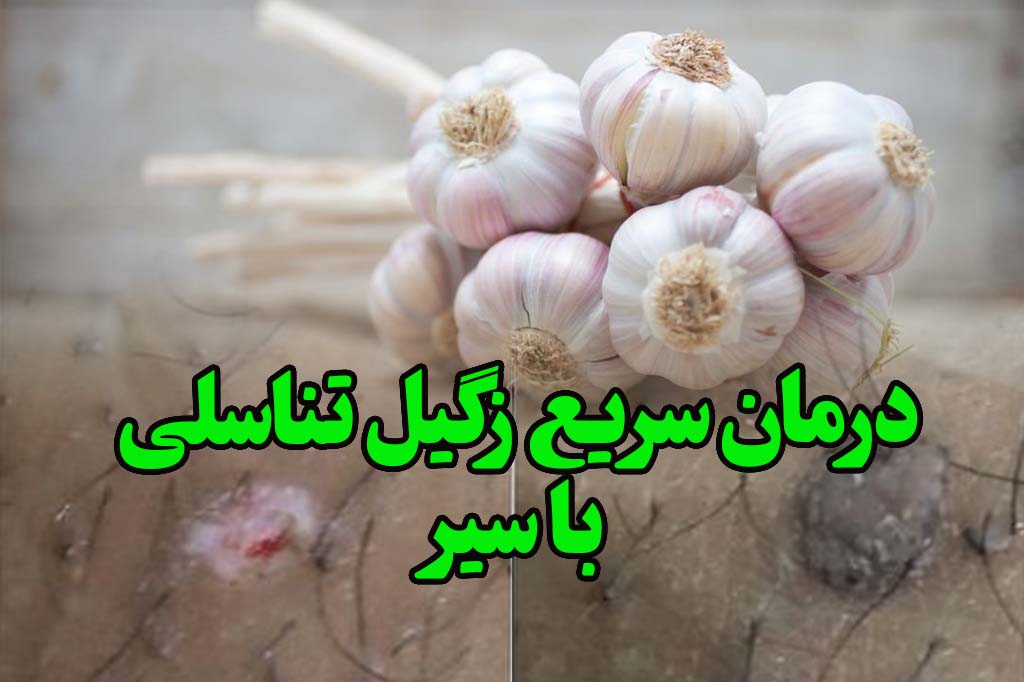 درمان سریع زگیل تناسلی با سیر در خانه