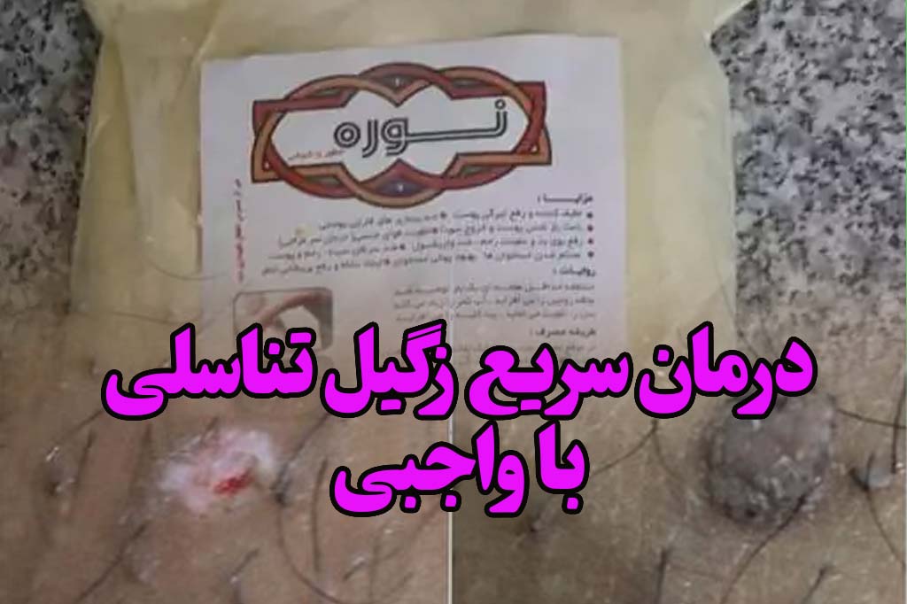 درمان زگیل با واجبی