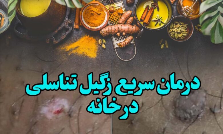 درمان سریع زگیل تناسلی در خانه