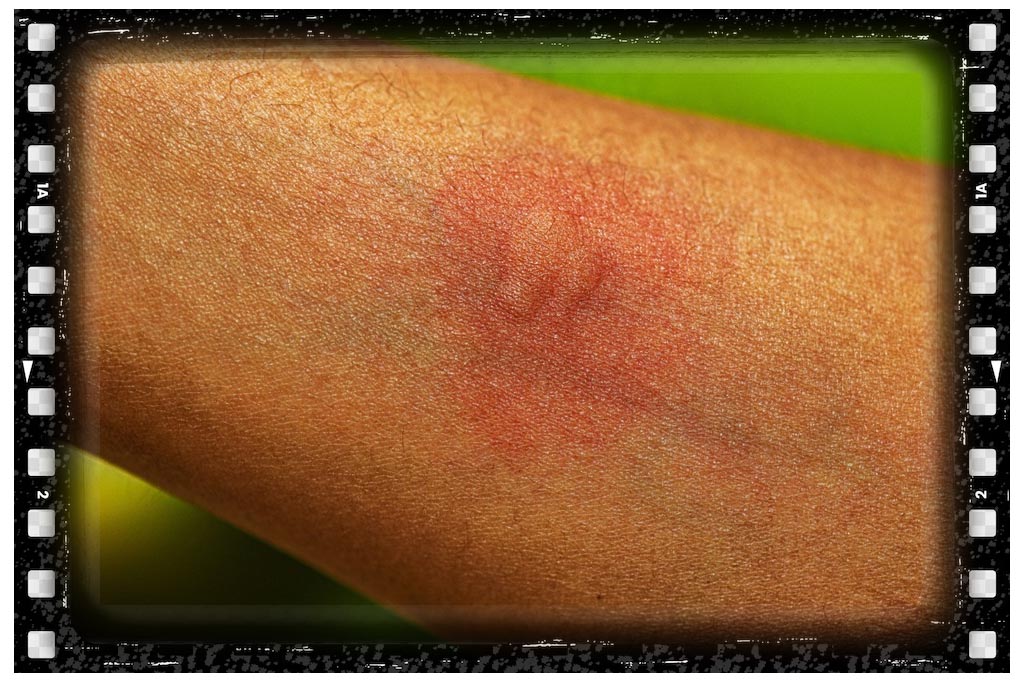 ادس جای نیش پشه