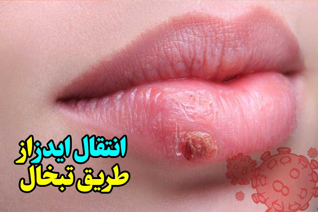 انتقال hiv از تبخال