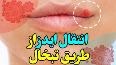 انتقال ایدز از طریق تبخال