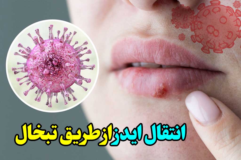 ایدز از تبخال منتقل