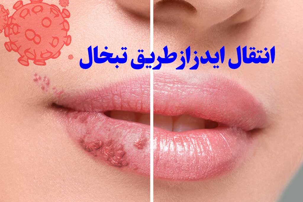 انتقال ایدز از تبخال