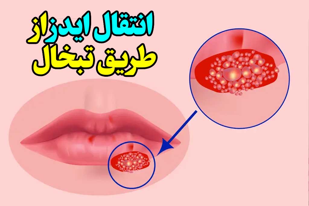 تبخال و انتقال ایدز