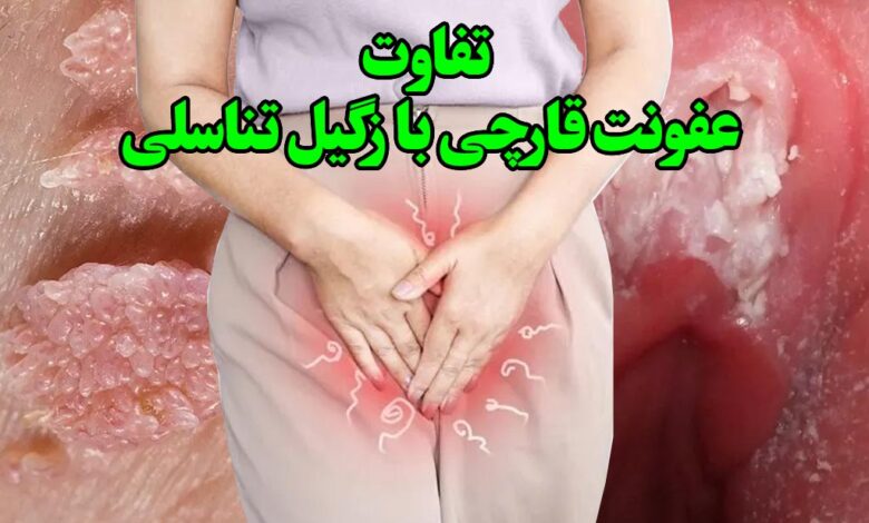تفاوت زگیل تناسلی با عفونت قارچی وازن