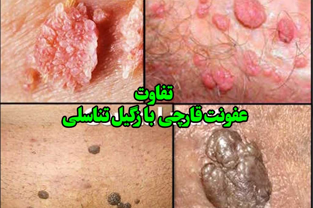 تفاوت ظاهری زگیل تناسلس با عفونت واژینال